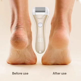 SAKER® Electric Callus Remover